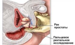 Рак простаты